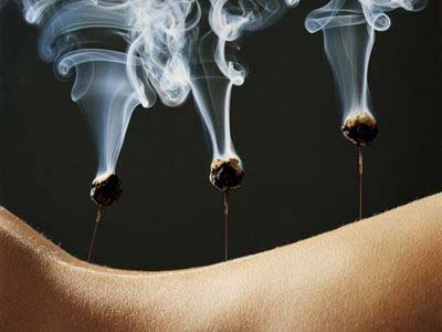 急性腰扭伤的治疗与护理