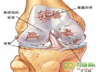 骨关节病到底有多可怕？
