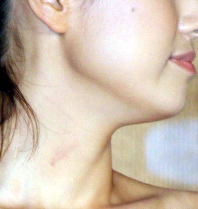 两性新知：吻痕携带需要健康指南