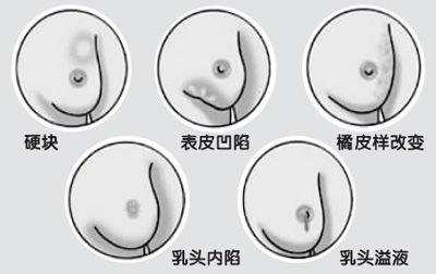 12种乳房样子一定要当心