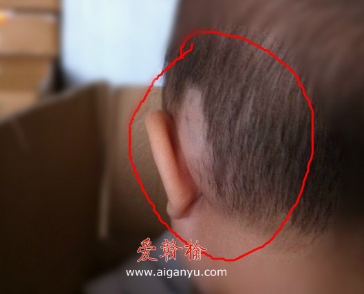 反映常州阳湖二院插针错误使病人头上起肿块