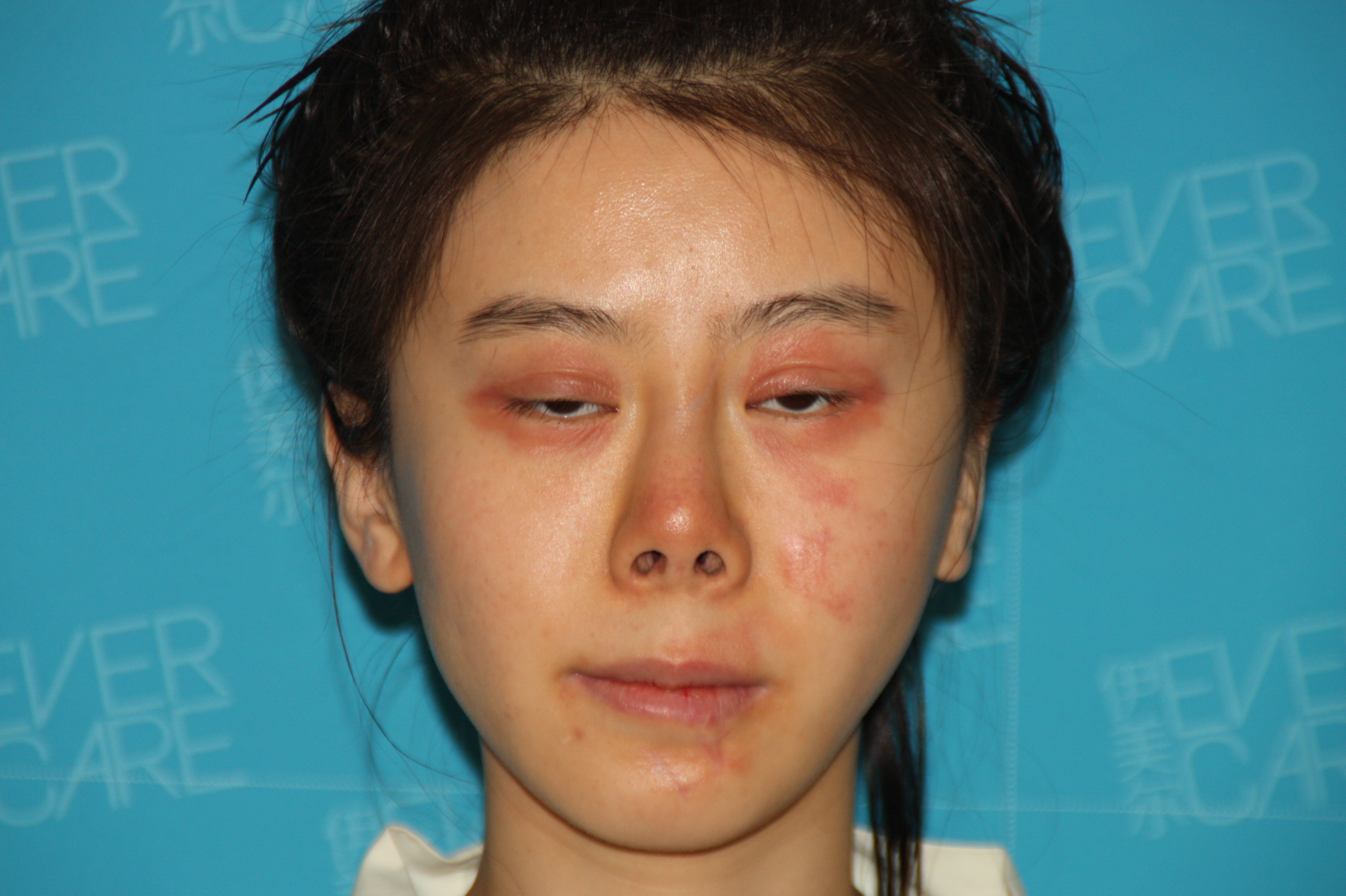 在伊美尔整容三年致毁容